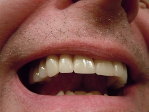 Zahnimplantate - Was muss ich über das Thema Zahnersatz wissen?